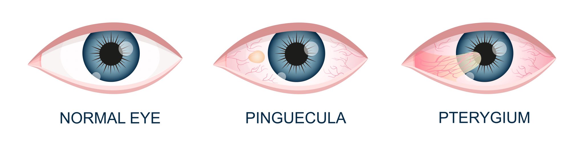 Pterygium Surgery in Kansas City, MO | Discover Vision