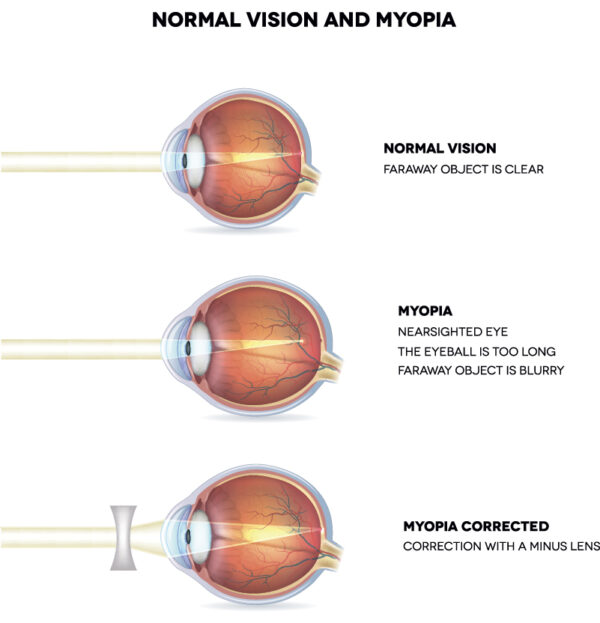 Myopia Surgery in Kansas City, MO | Discover Vision