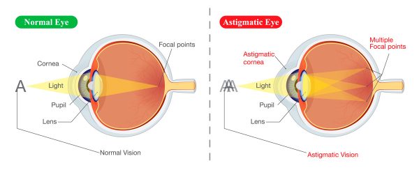 Astigmatism Correction in Kansas City, MO | Discover Vision