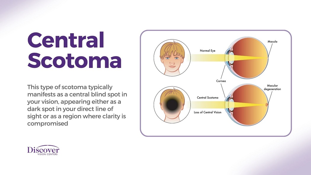 Scotoma: Blind Spot in Vision | Discover Vision