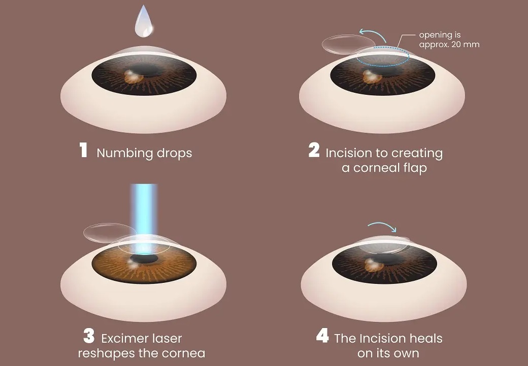 is-smile-eye-surgery-safe-discover-vision