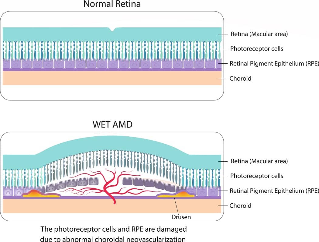 Wet Vs. Dry Macular Degeneration: What’s The Difference? | Discover Vision