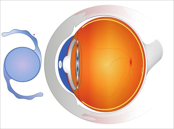 ICL vs. RLE: What Are the Differences? | Discover Vision