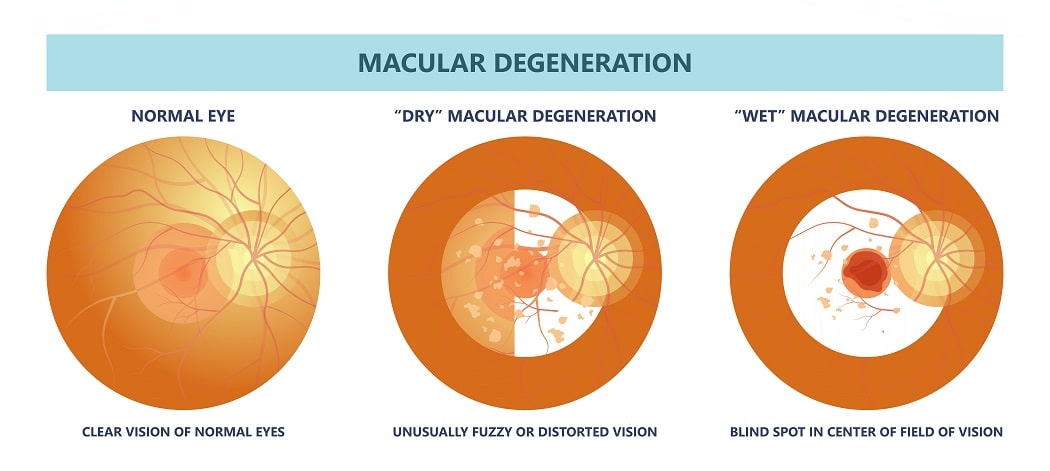 Wet Vs Dry Macular Degeneration Whats The Difference Discover Vision 