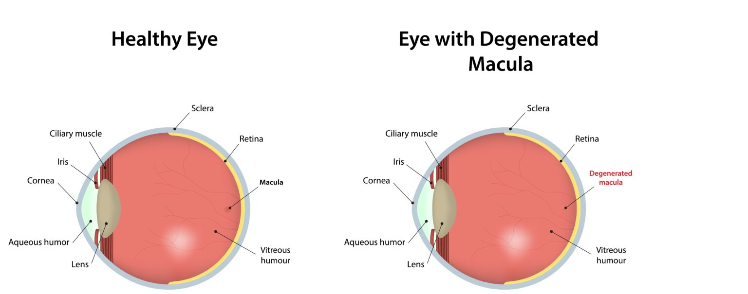 Macular Degeneration Treatment in Kansas City, MO | Discover Vision